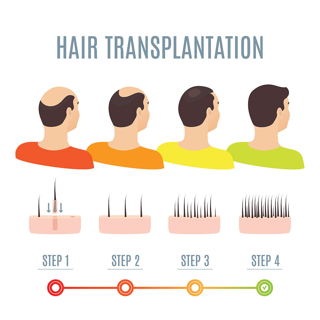 Hair transplantation, illustration