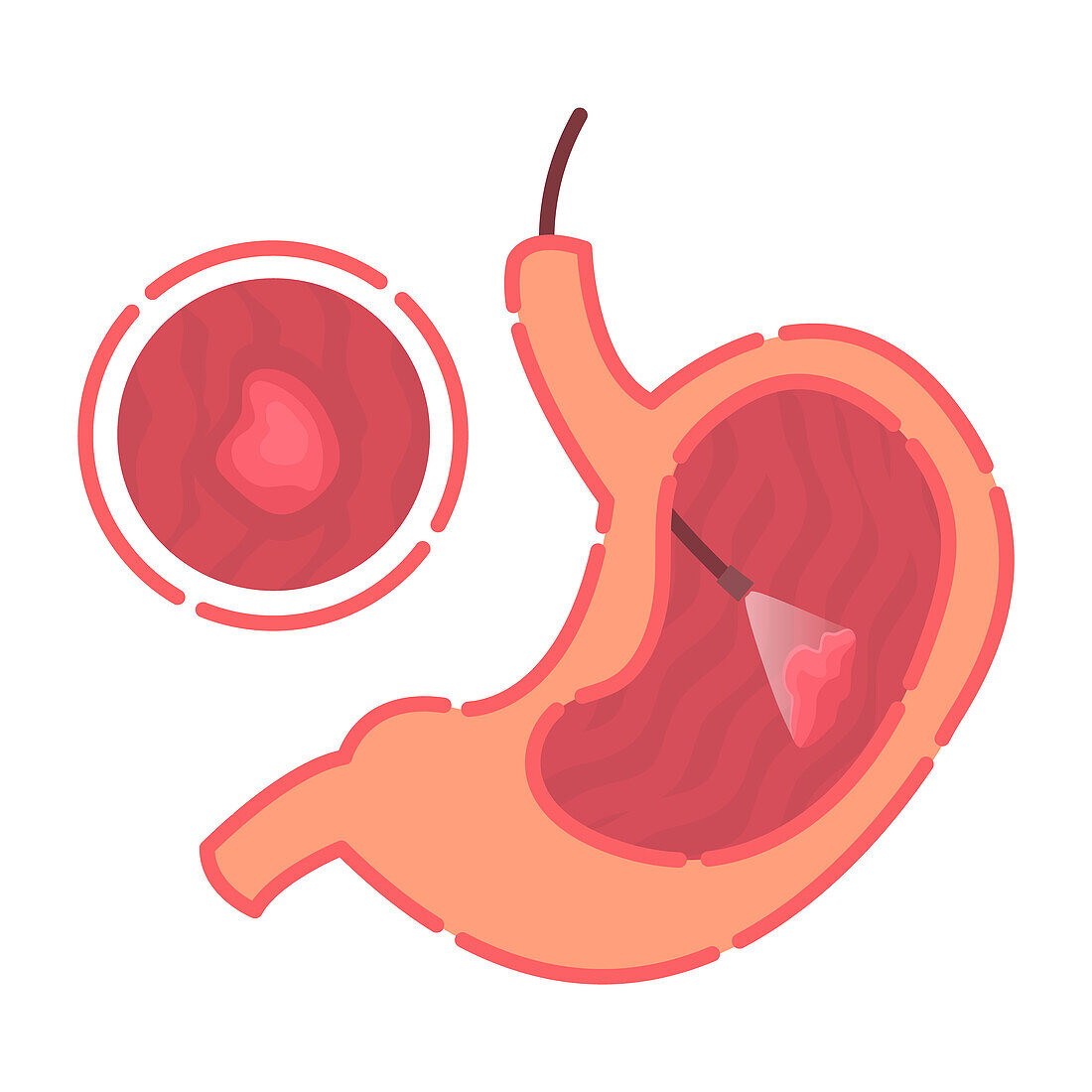Stomach gastroscopy, illustration