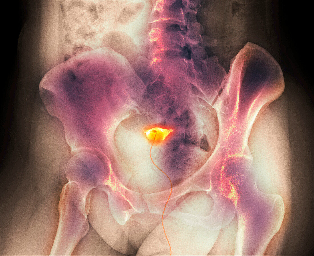 Blocked fallopian tube, X-ray