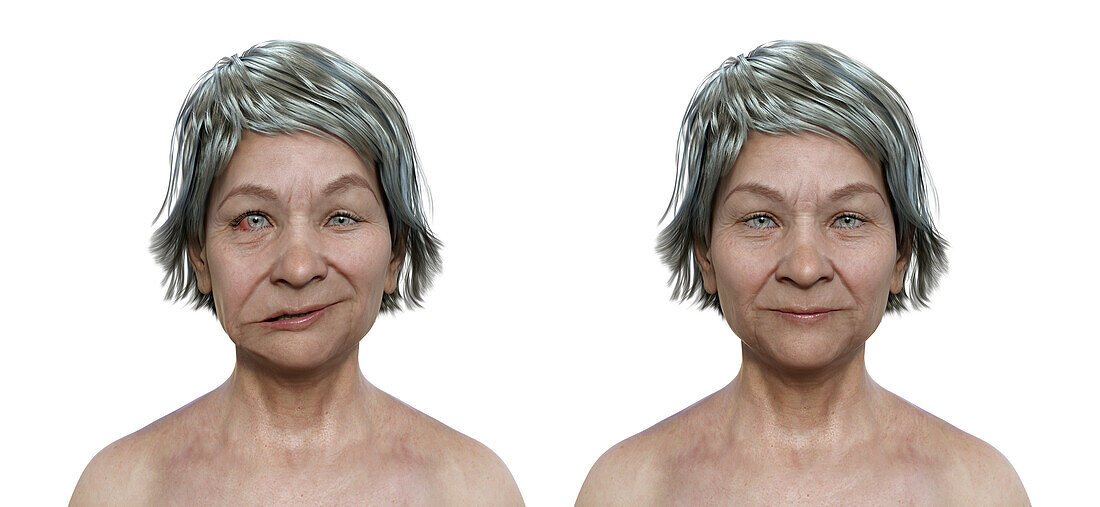 Healthy woman and woman with facial palsy, illustration