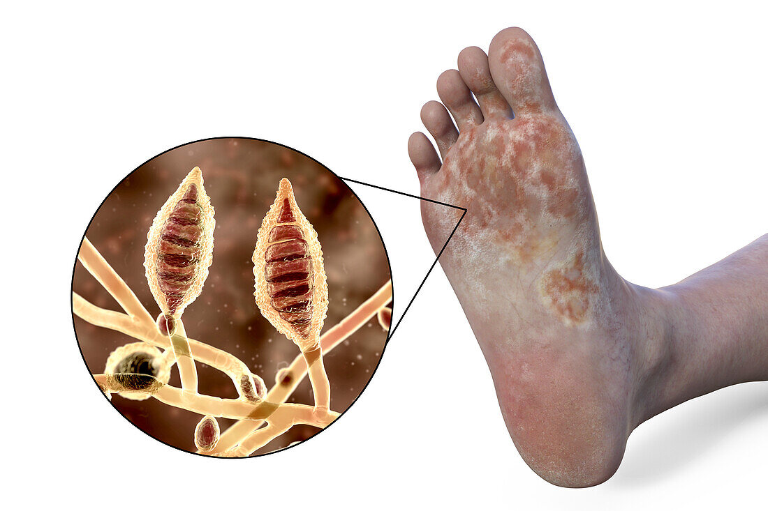 Microsporum canis infection of the foot, illustration
