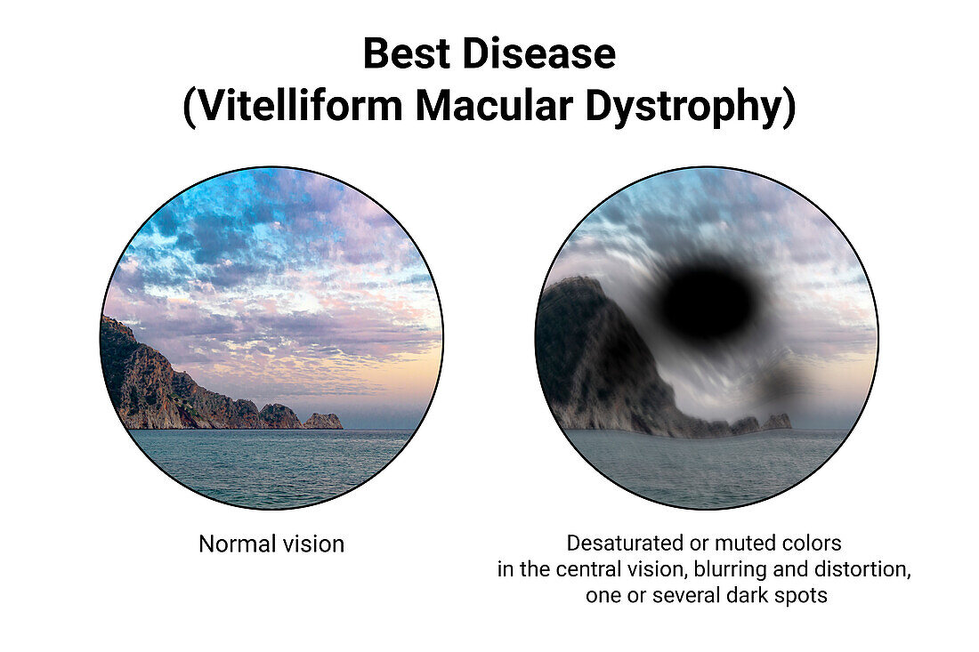 Normal eye and an eye with Best disease, illustration