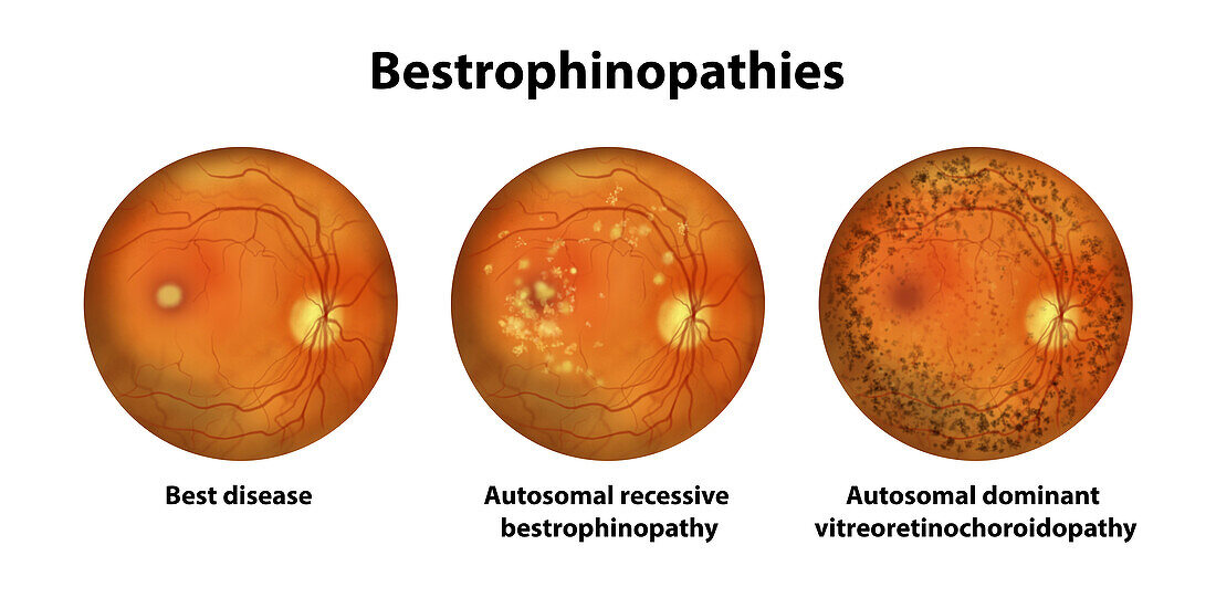Bestrophinopathies, illustration