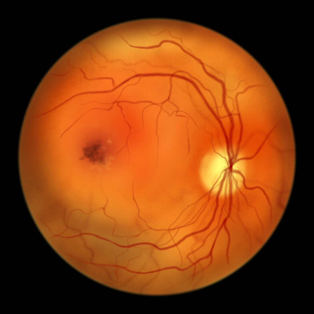 Best vitelliform macular dystrophy, illustration