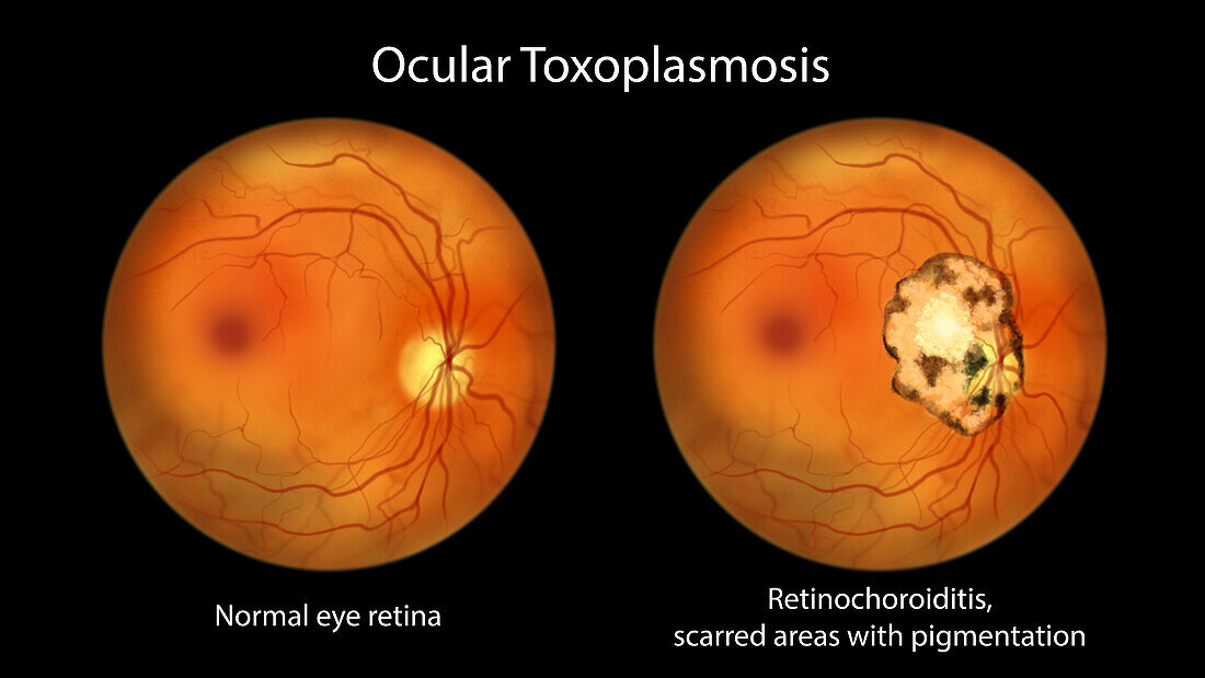 Retinal scar and healthy retina, illustration