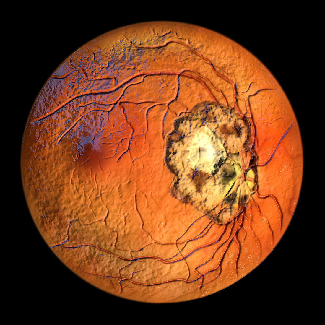 Retinal scar caused by toxoplasmosis, illustration