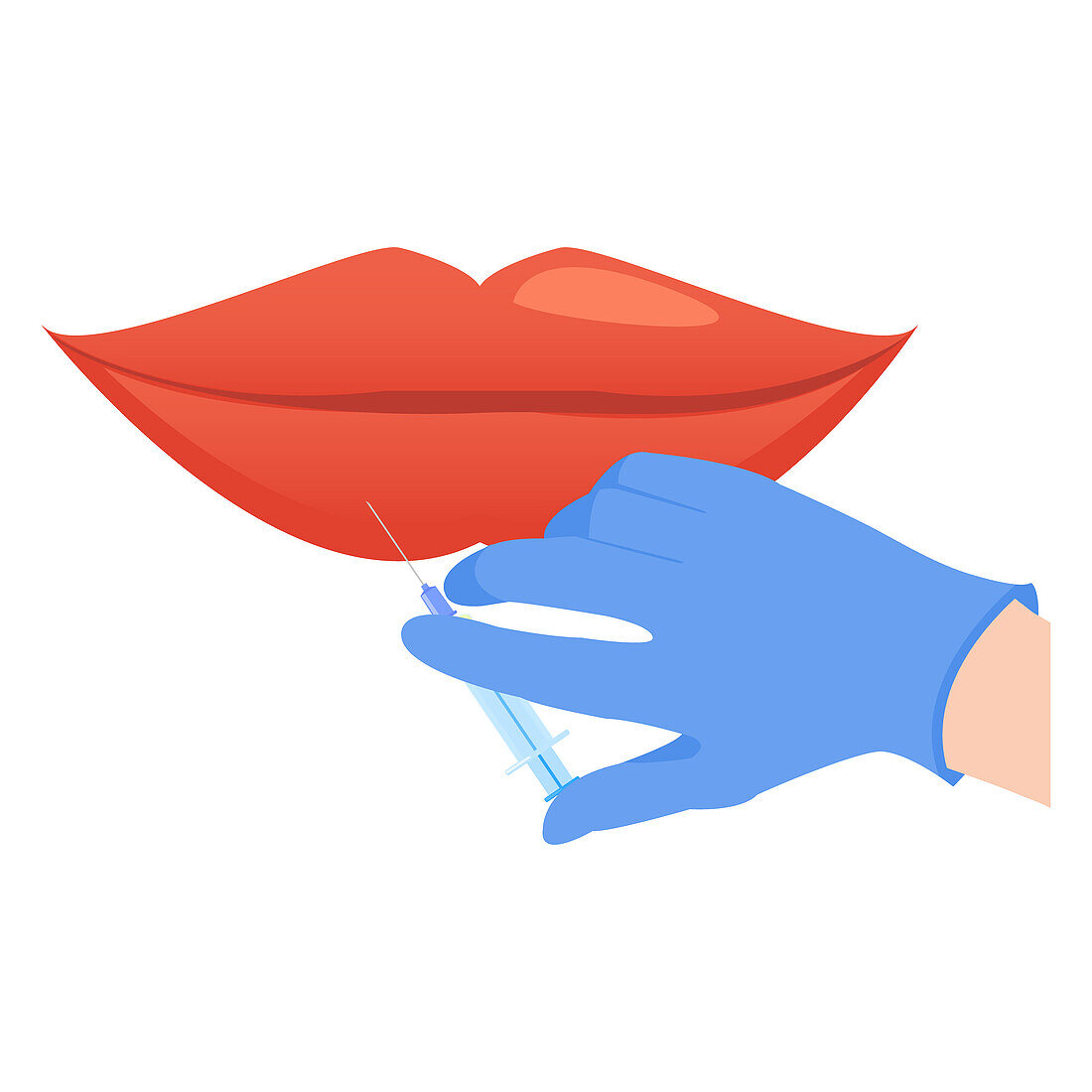 Lip augmentation, illustration