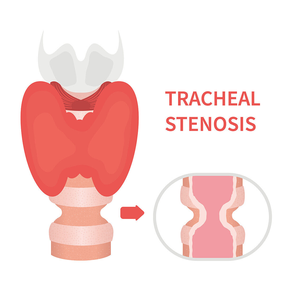 Tracheal stenosis, illustration