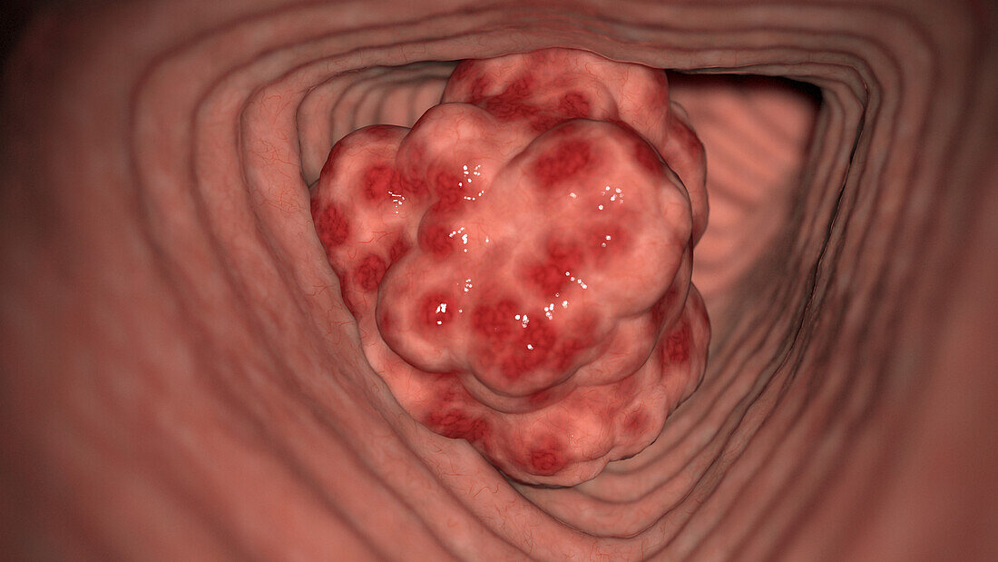 Colon cancer, illustration