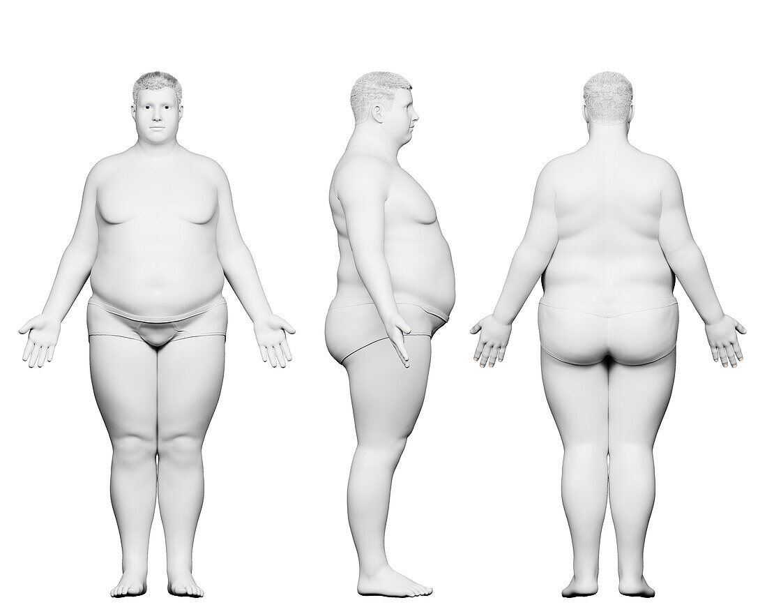 Obese male body, illustration