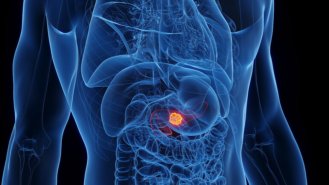Pancreatic cancer, illustration