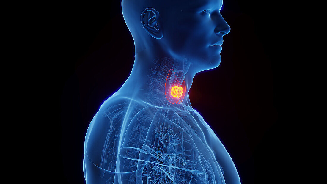 Thyroid cancer, illustration