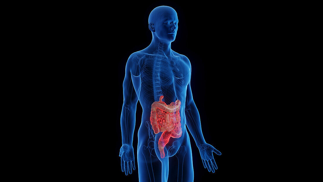 Intestines affected by Crohn's disease, illustration