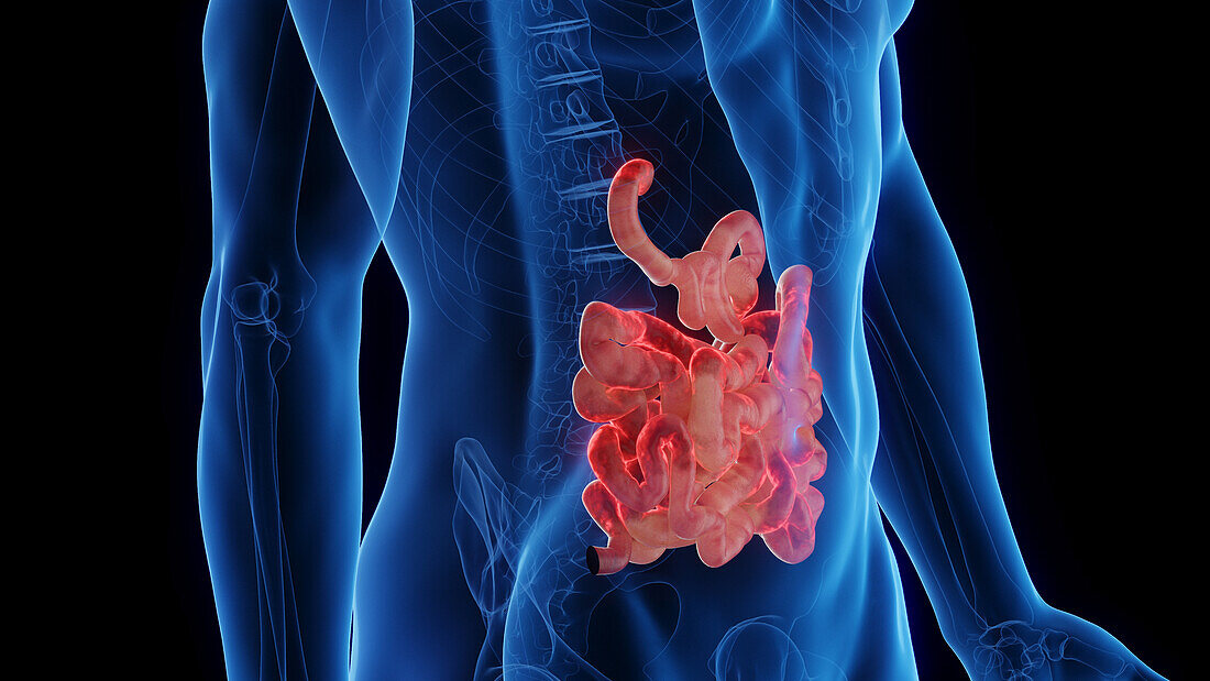 Inflamed small intestine, illustration