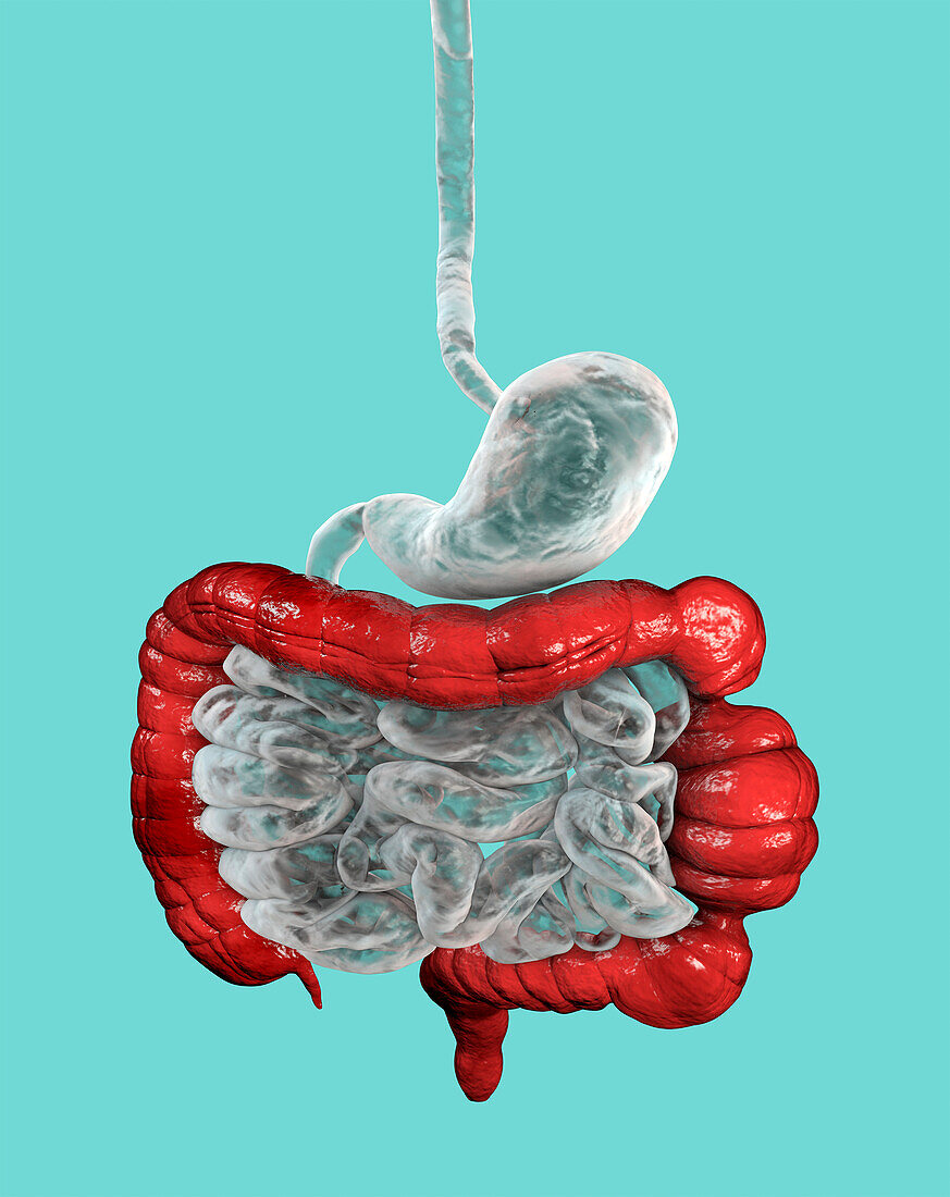 Irritable bowel syndrome, illustration
