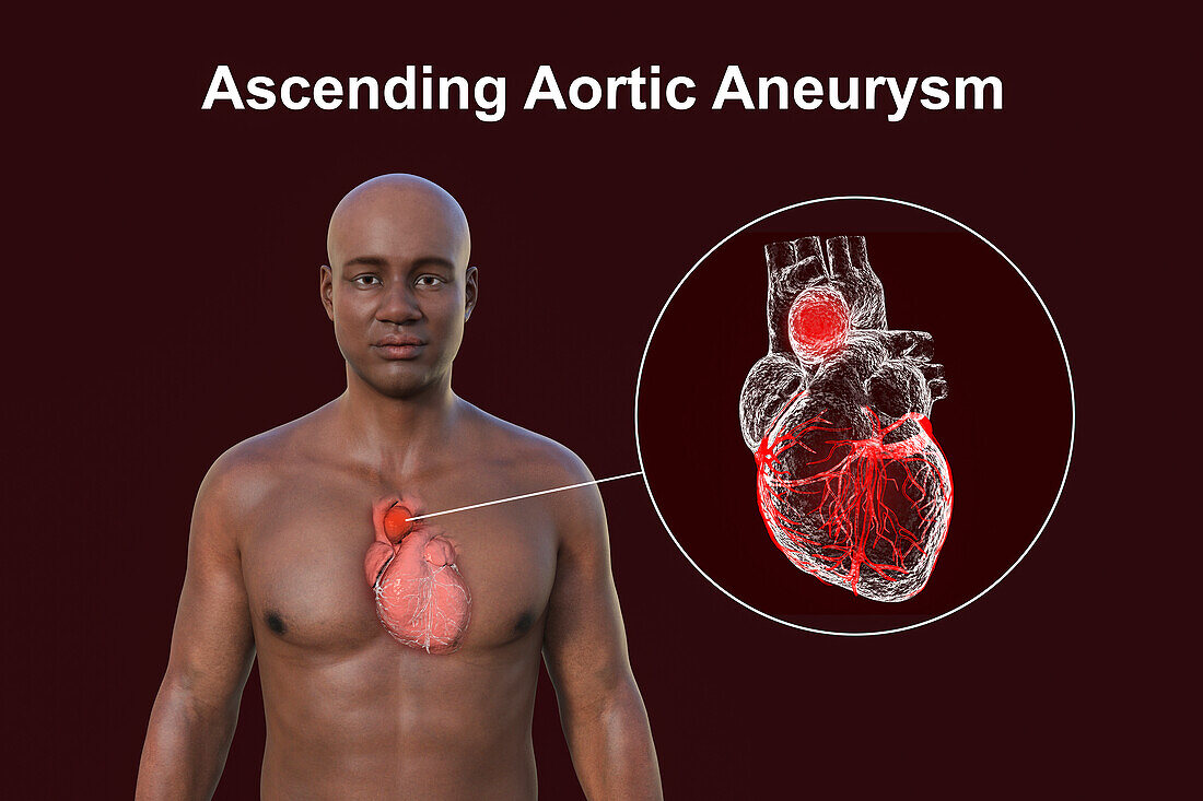 Ascending aortic aneurysm, illustration