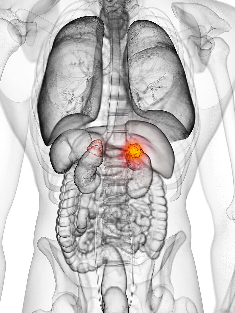 Adrenal gland cancer, illustration
