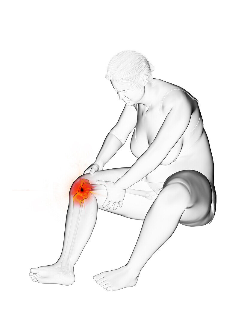 Overweight woman with painful knee joint, illustration