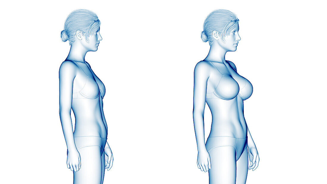 Woman after breast enlargement, illustration