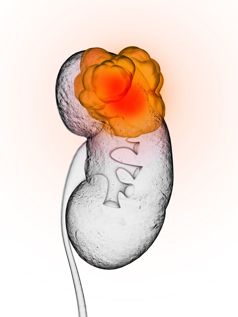 Kidney cancer, illustration