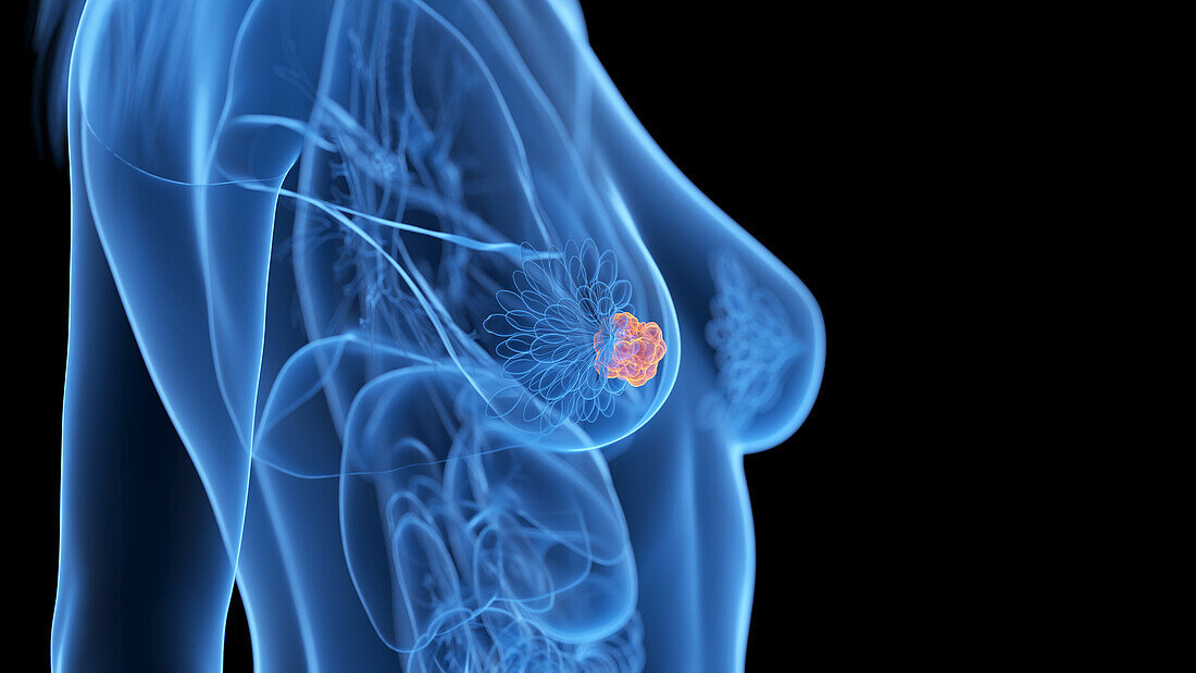 Breast cancer, illustration