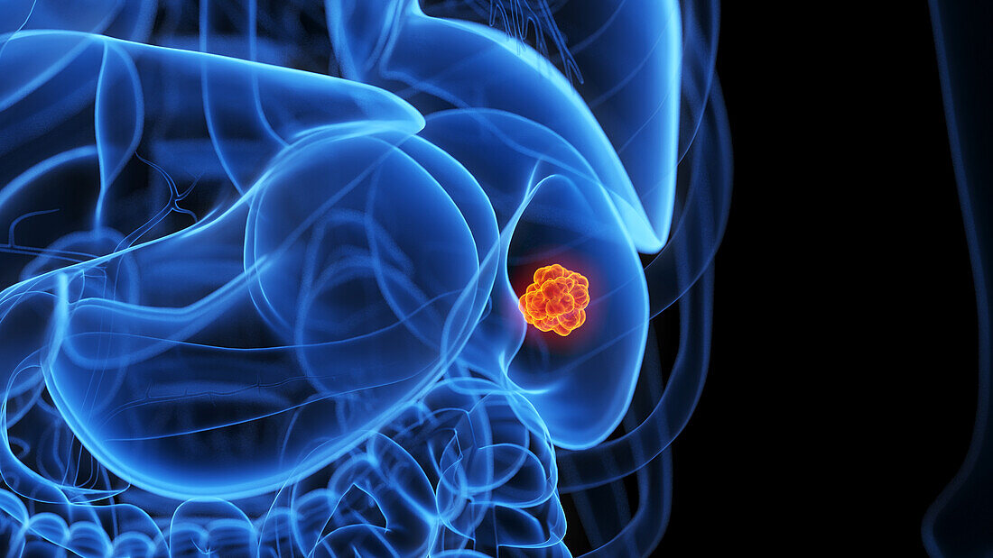 Spleen tumour, illustration