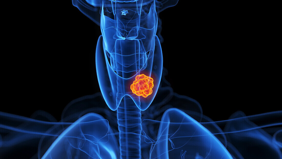 Thyroid tumour, illustration
