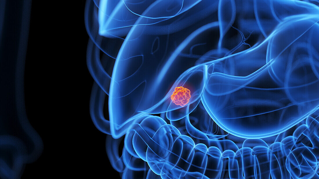 Gallbladder tumour, illustration