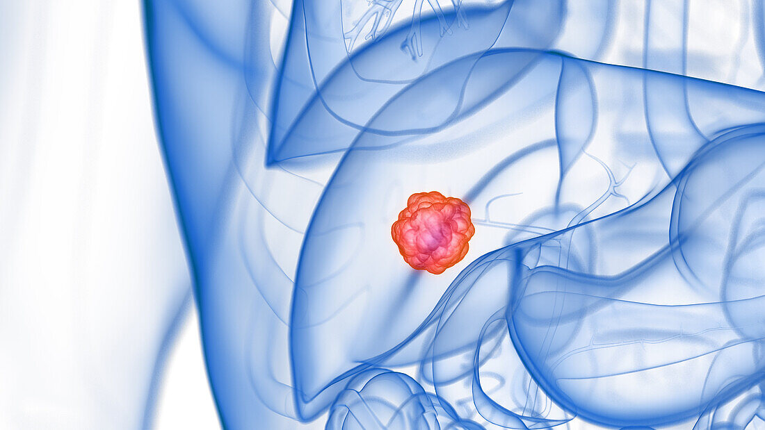 Liver tumour, illustration
