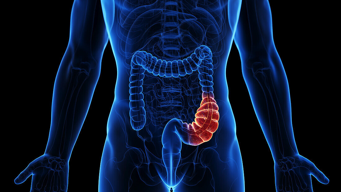 Constipated colon, illustration