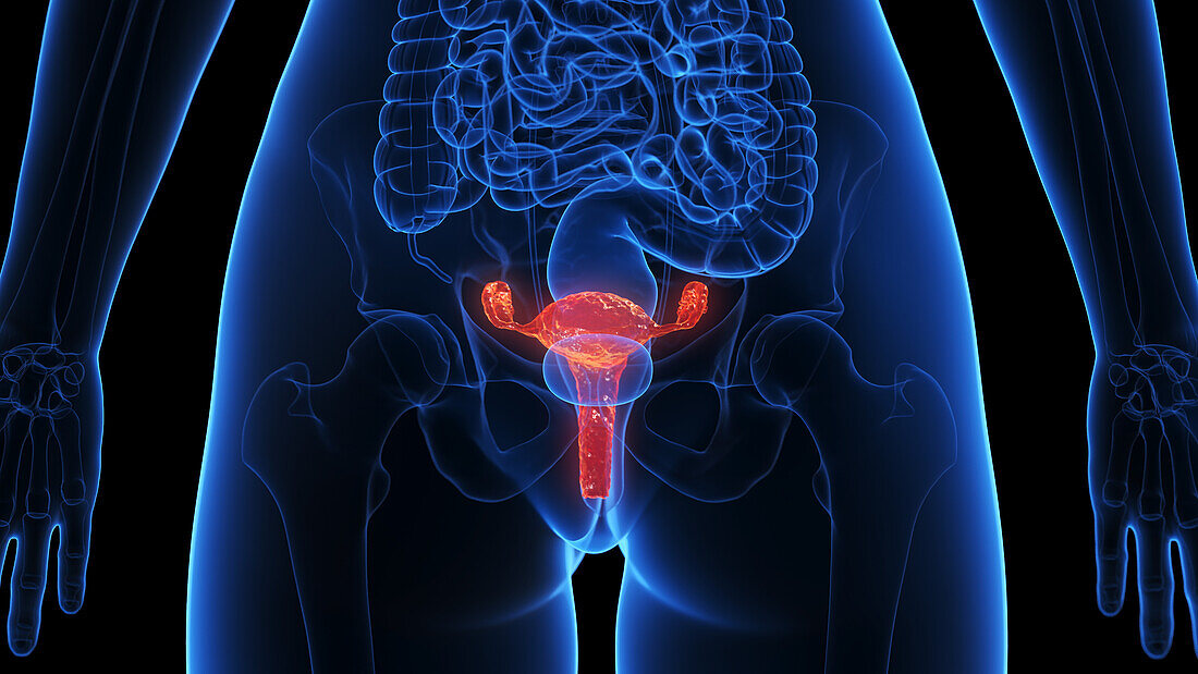Inflamed uterus, illustration