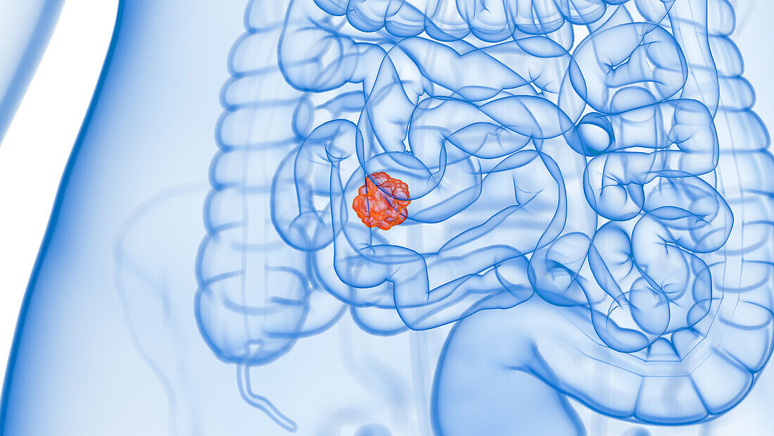 Small intestine tumour, illustration