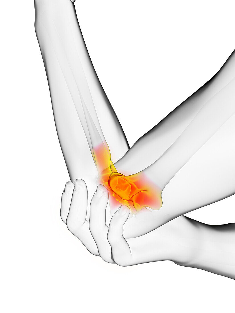 Man with painful elbow, illustration