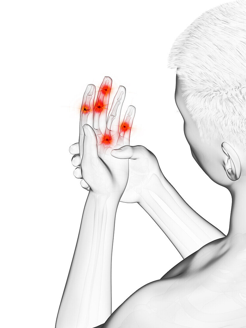 Painful finger joints, illustration