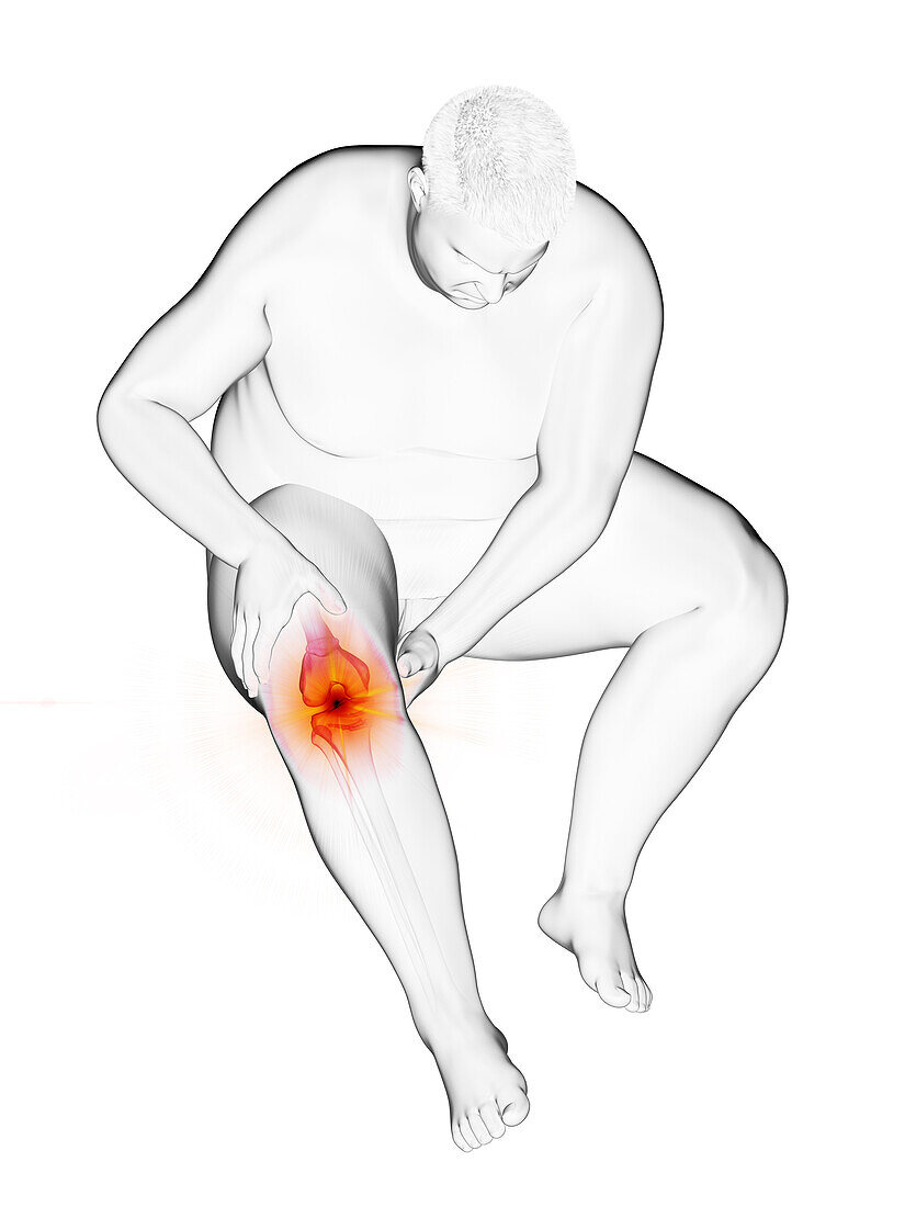 Obese man's painful knee, illustration
