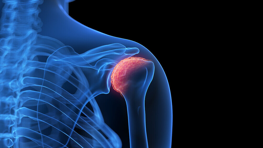 Arthritic shoulder joint, illustration