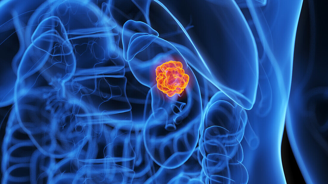 Kidney tumour, illustration