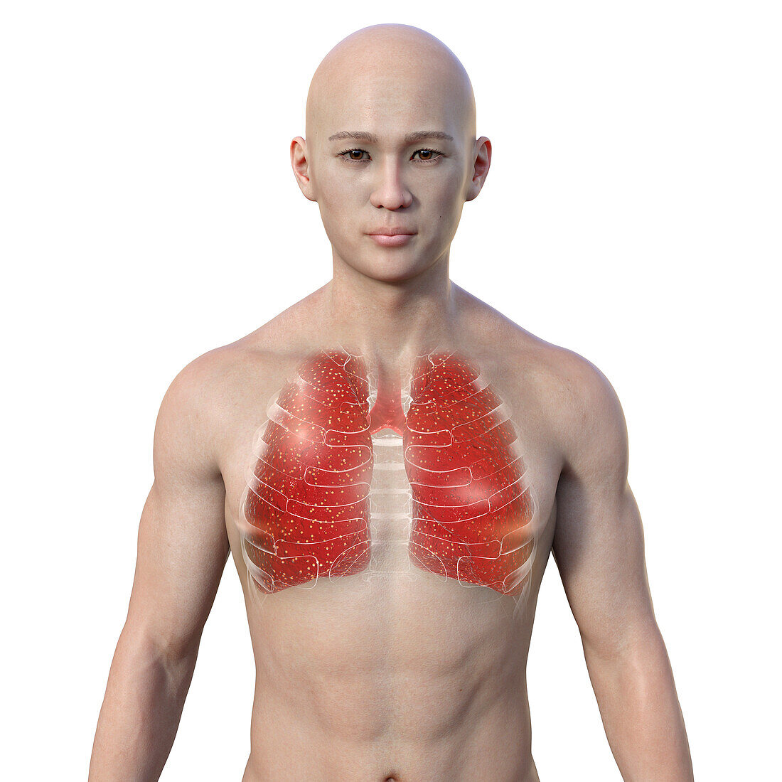 Man with miliary tuberculosis, illustration