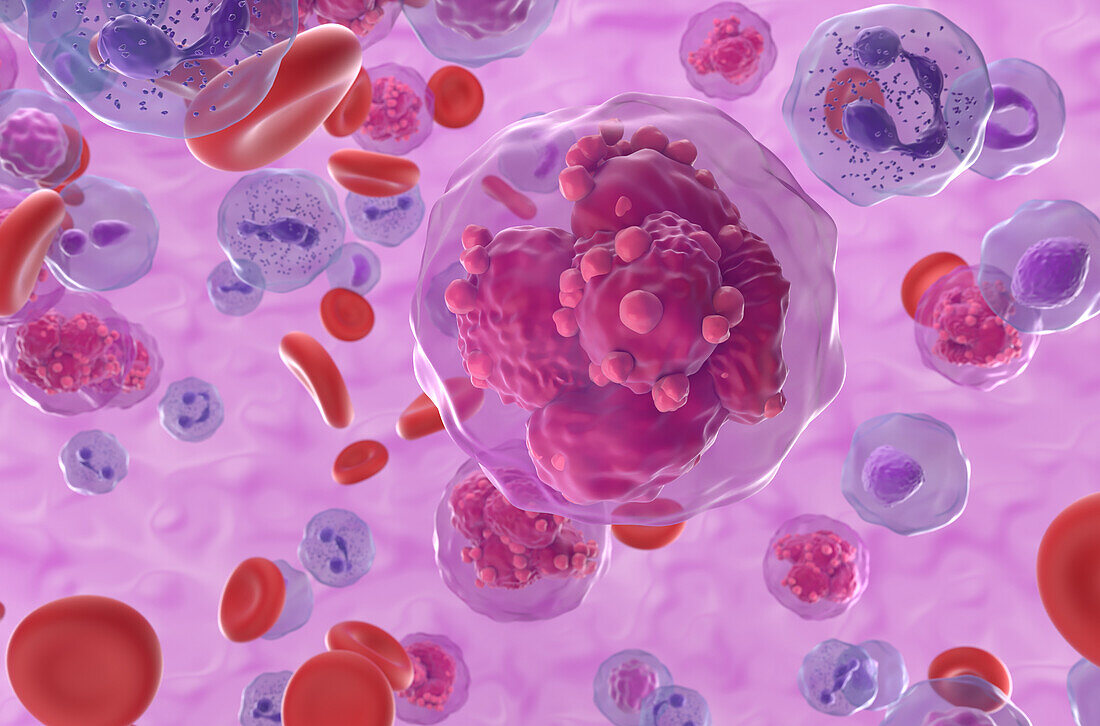 Acute lymphoblastic leukemia, illustration