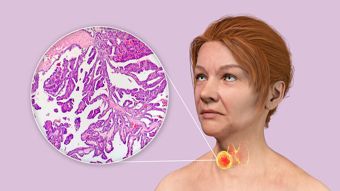 Woman with thyroid cancer, illustration