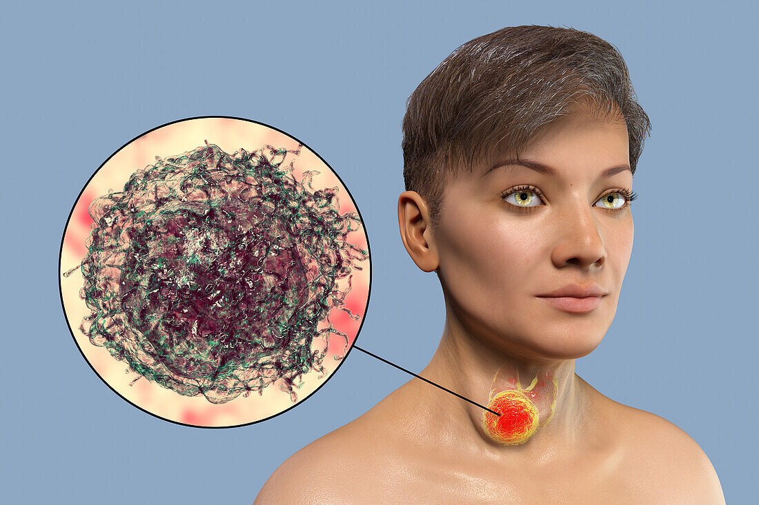 Woman with thyroid cancer, illustration