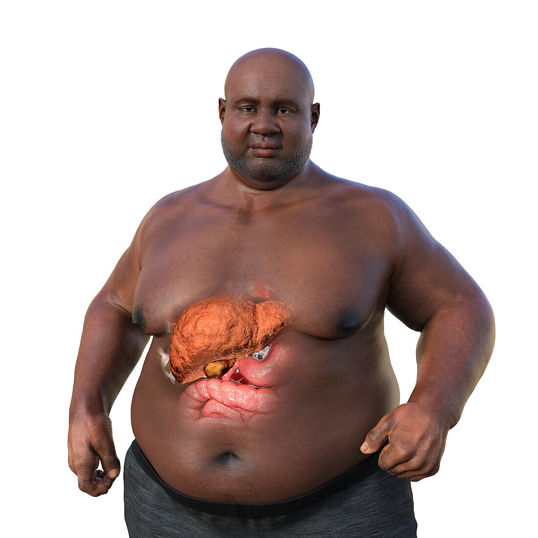 Overweight man with steatosis, illustration
