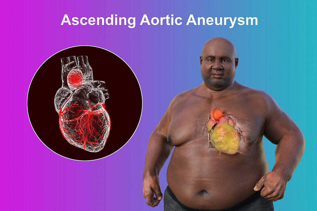 Obese man with ascending aortic aneurysm, illustration