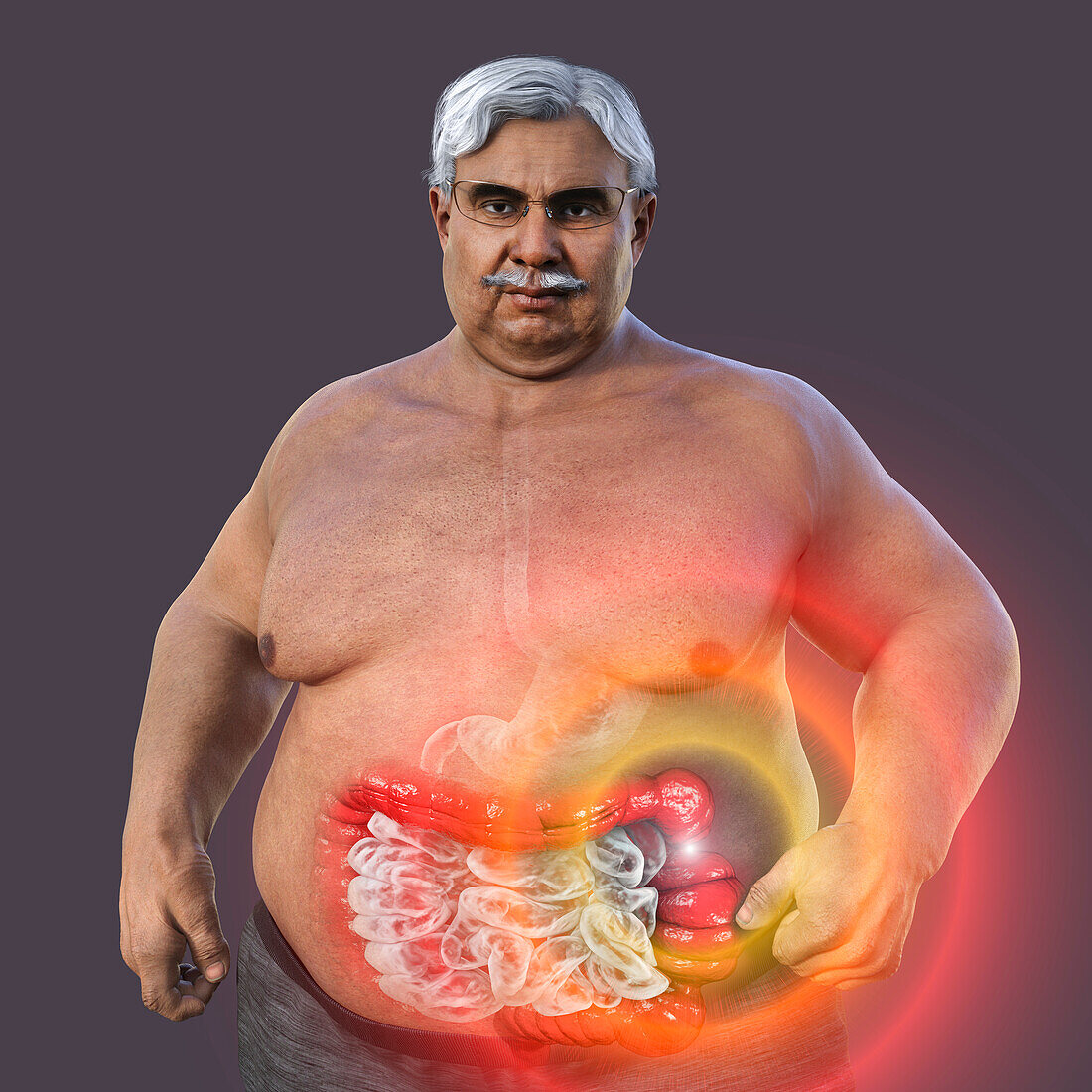 Irritable bowel syndrome, illustration