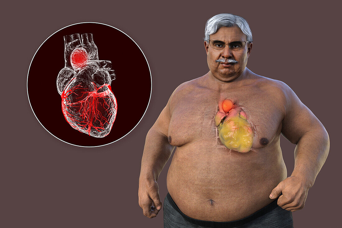 Obese man with ascending aortic aneurysm, illustration