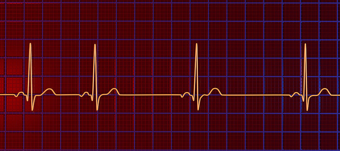 Sinus arrhythmia heartbeat rhythm, illustration