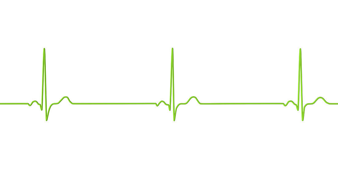 Sinus bradycardia heartbeat rhythm, illustration