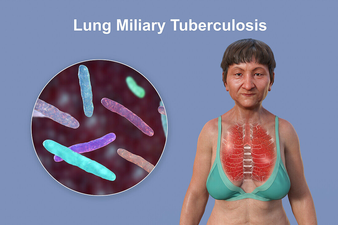 Miliary tuberculosis, illustration