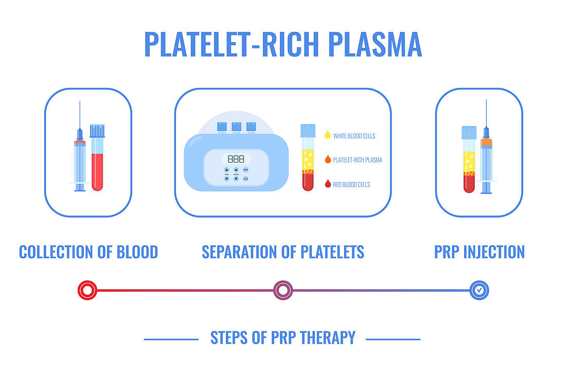 Platelet rich plasma procedure, conceptual illustration