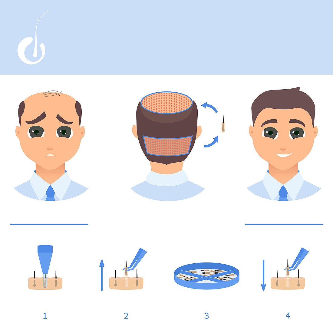 Male hair loss FUE treatment, illustration